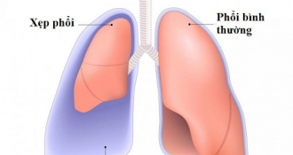 Tràn khí màng phổi: Nguyên nhân, triệu chứng và cách điều trị